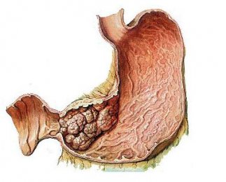 胃惡性腫瘤的病因詳解