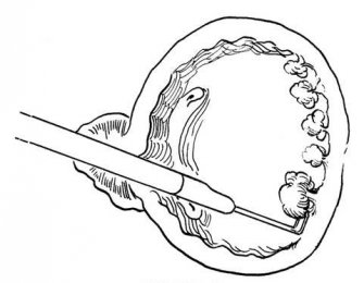 不開(kāi)刀治療膀胱腫瘤——經(jīng)尿道膀胱腫瘤電切術(shù)