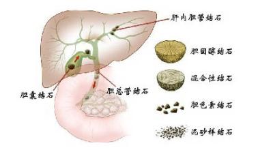 膽道切開(kāi)取石術(shù)