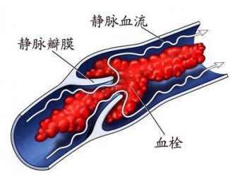 靜脈溶栓為急性腦梗死患者帶來(lái)福音