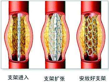 冠脈支架植入術